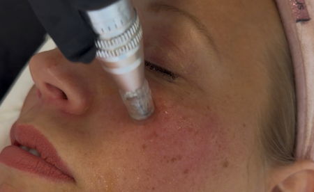Ansiktsbehandling - Microneedling