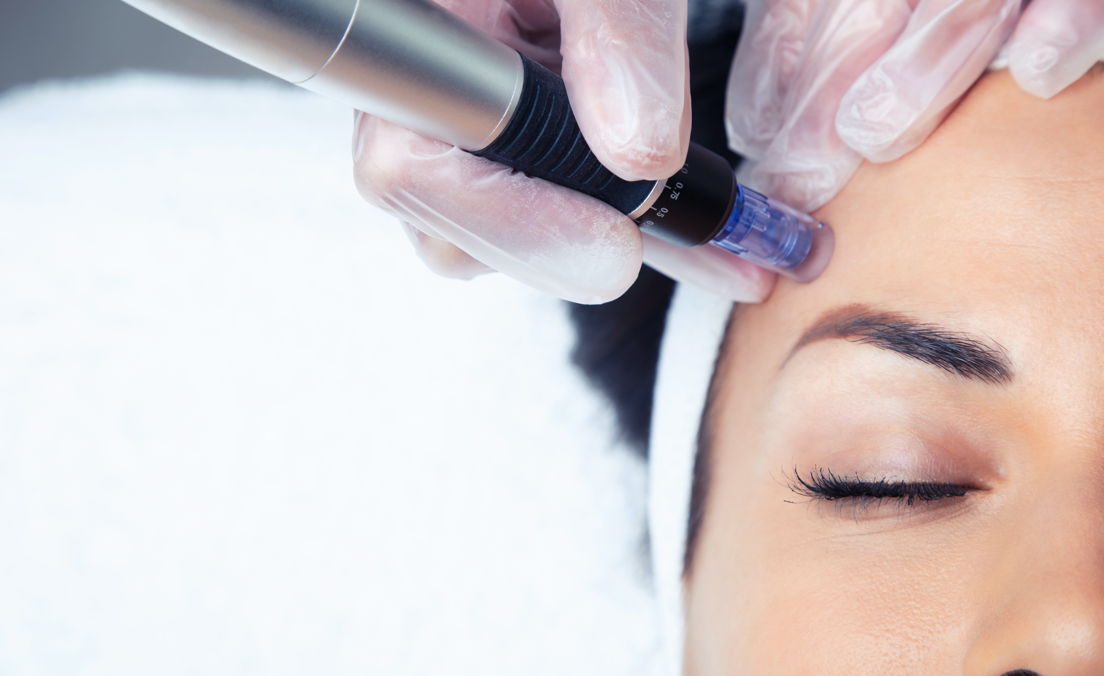 Skinpen (microneedling)